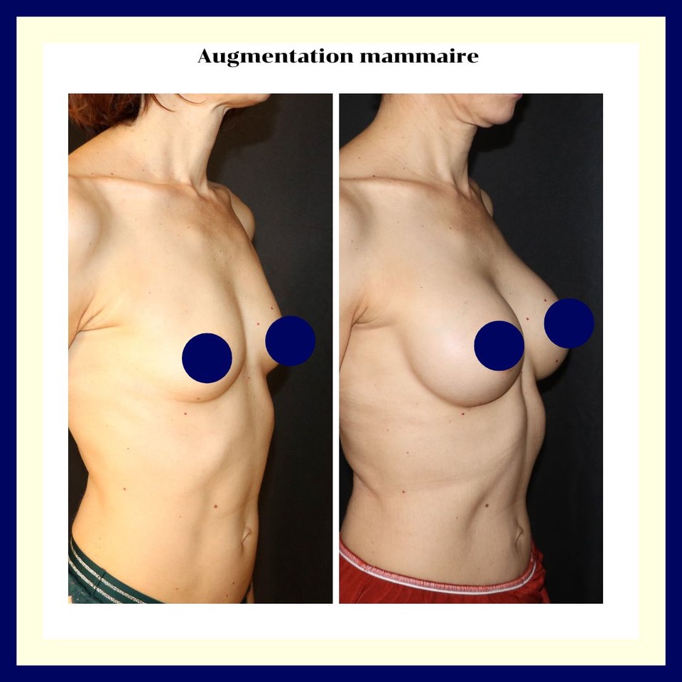 Metz chirurgie esthétique du sein par implants mammaires